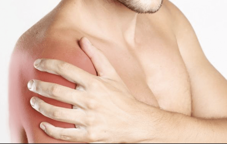 dolor d'espatlla, pinçament, impingment, síndrome pinçament subacromial, espatlla